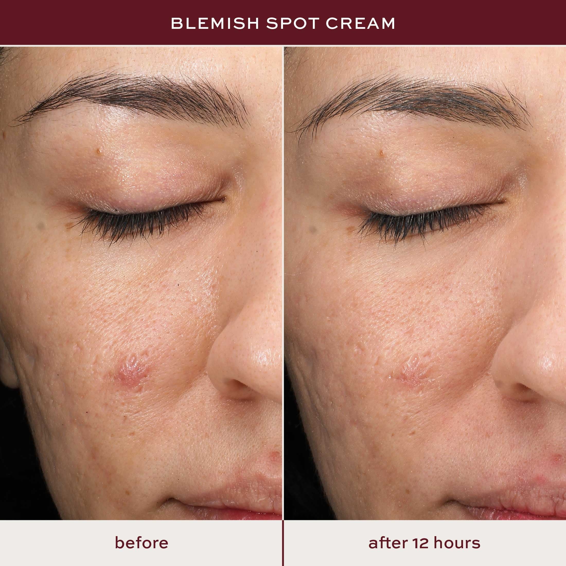 ITK Skincare Blemish Acne Spot Treatment with 0.5% Salicylic Acid + Tea Tree Oil for All Skin Types, 0.5 oz
