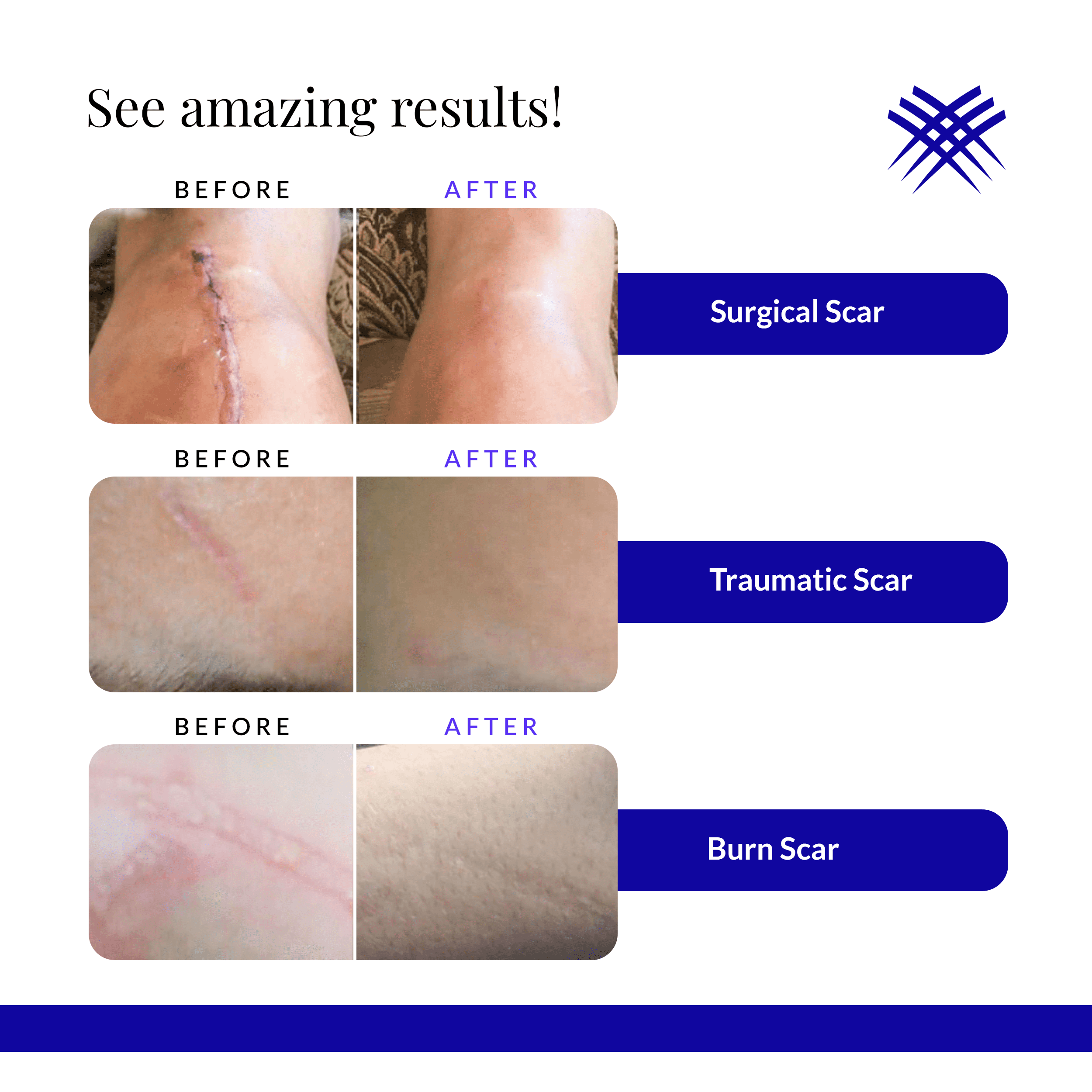 Rejuvaskin Rejuvasil Silicone Scar Gel – Scar Treatment for Surgical Scars for Face, Body, Burn, Keloids, & Acne – Silicone Gel for Scars to Reduced the Appearance of Old & New Scar - 0.33 ounce