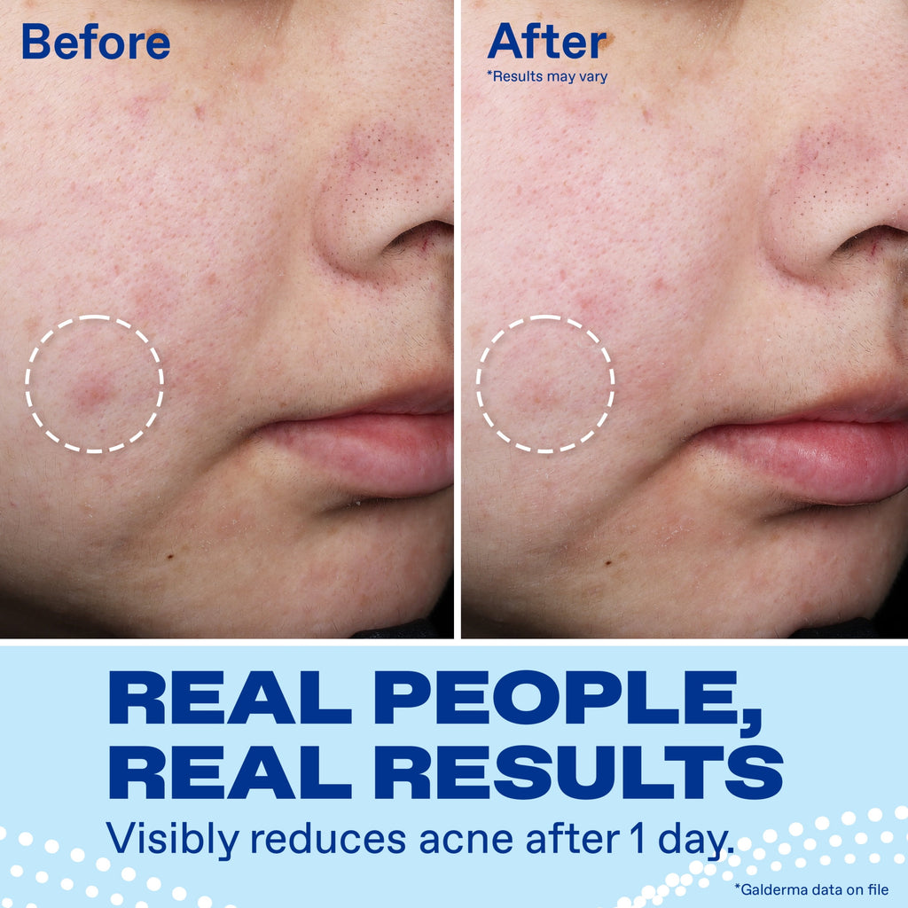 Differin Acne Spot Treatment with 10% Benzoyl Peroxide, Maximum Strength, Fast-Acting, Acne Treatment for Face & Body, 1 oz