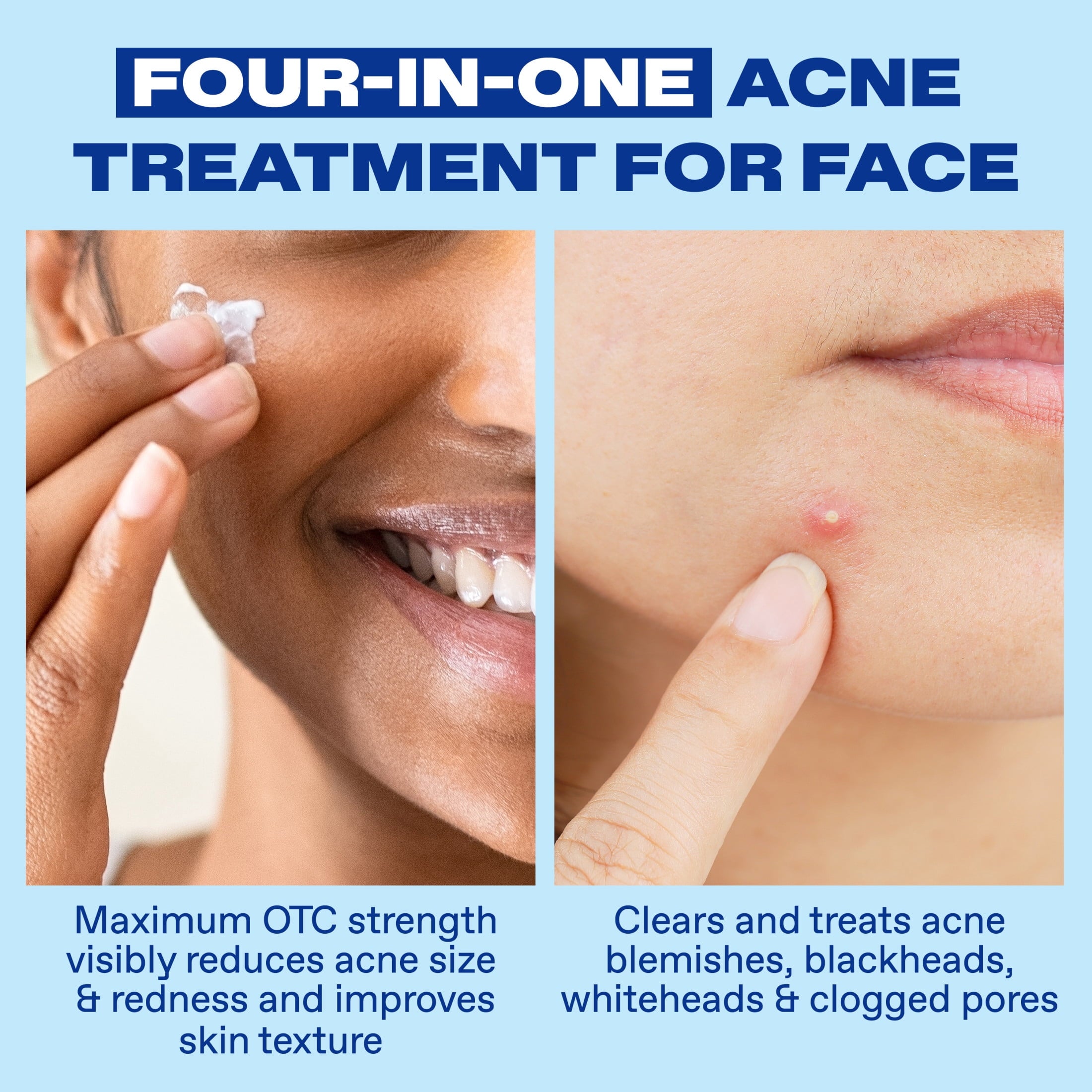 Differin Acne Spot Treatment with 10% Benzoyl Peroxide, Maximum Strength, Fast-Acting, Acne Treatment for Face & Body, 1 oz
