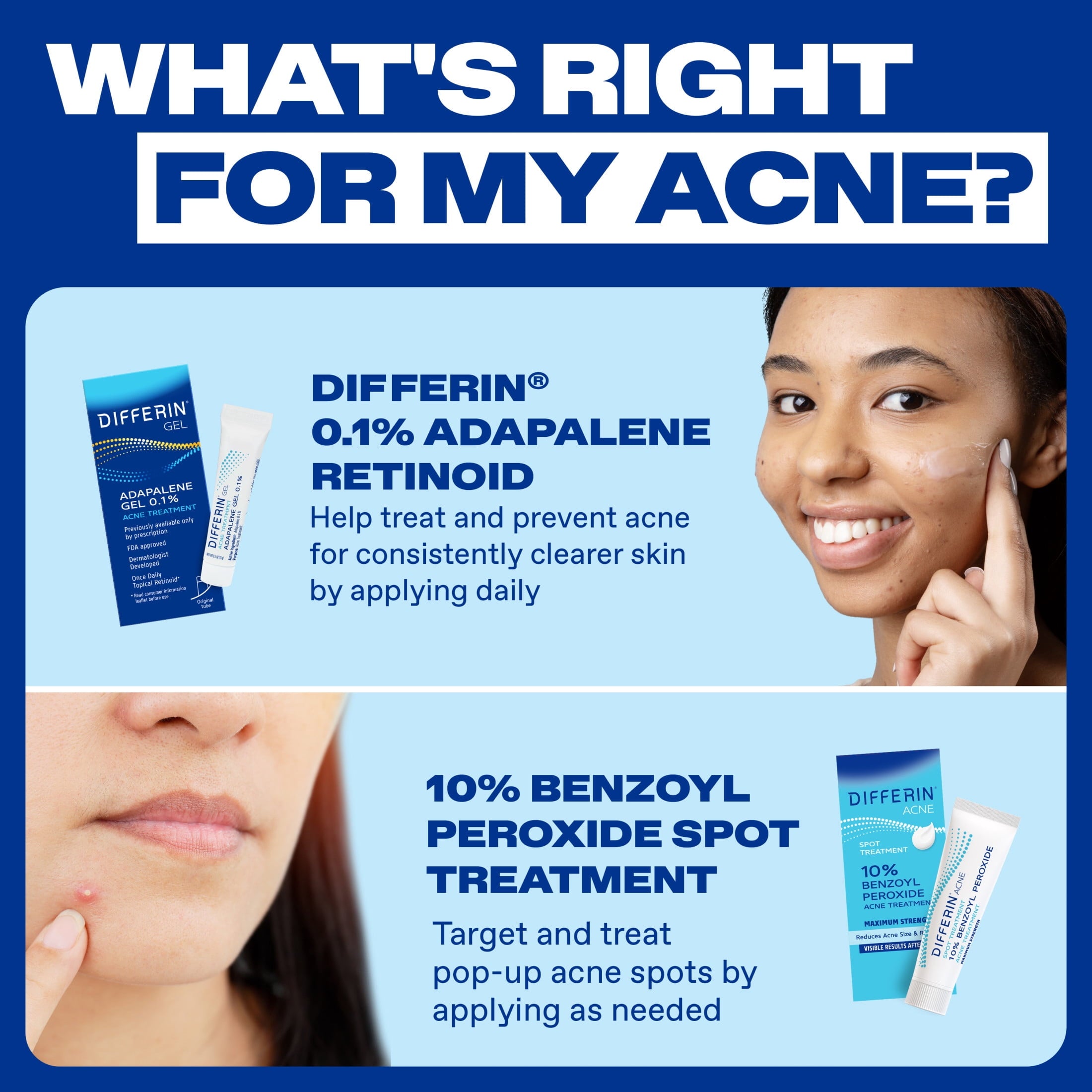 Differin Acne Spot Treatment with 10% Benzoyl Peroxide, Maximum Strength, Fast-Acting, Acne Treatment for Face & Body, 1 oz