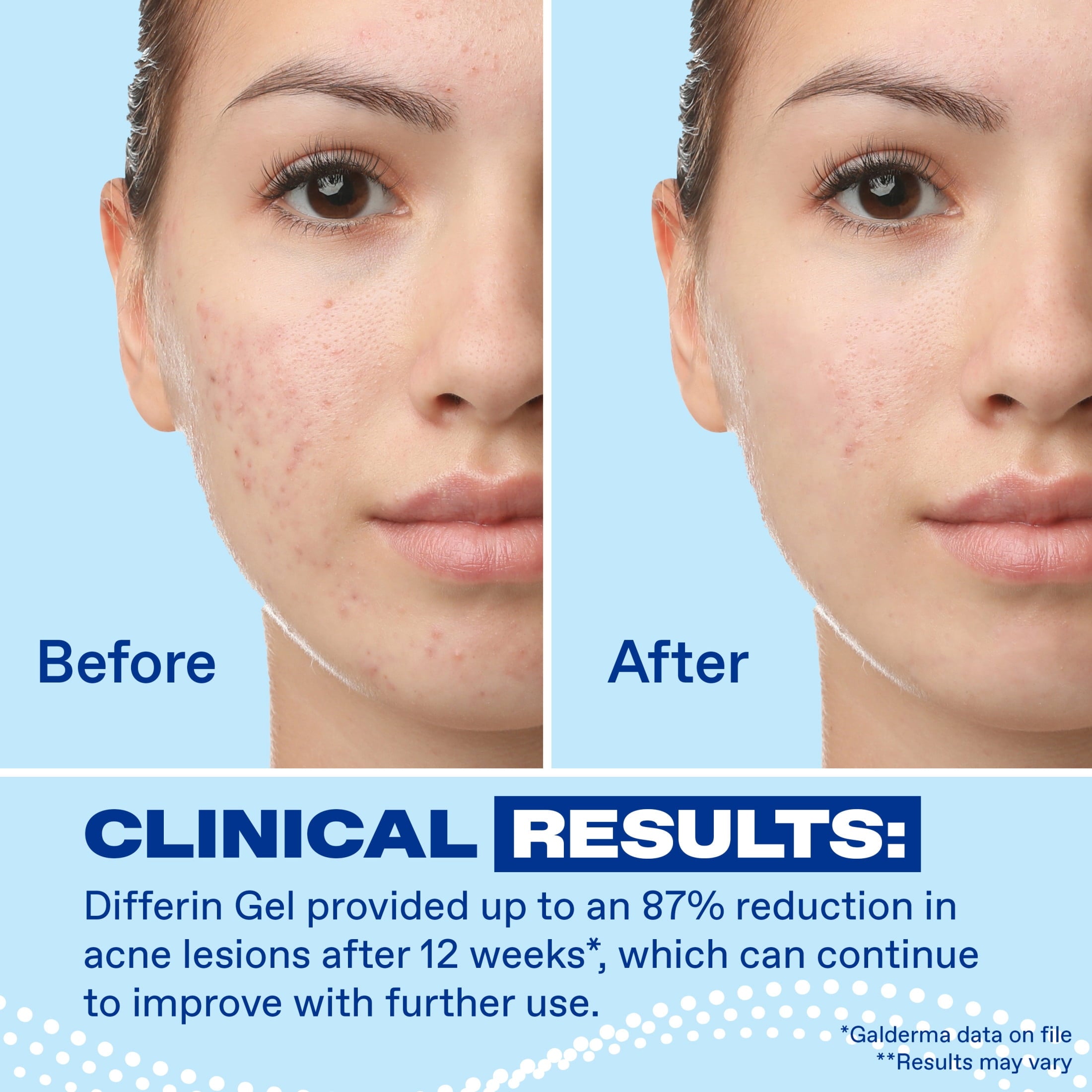 Differin Acne Treatment Gel, Retinoid Treatment for Face with 0.1% Adapalene, Gentle Skin Care for Acne Prone Sensitive Skin, 1.6 OZ